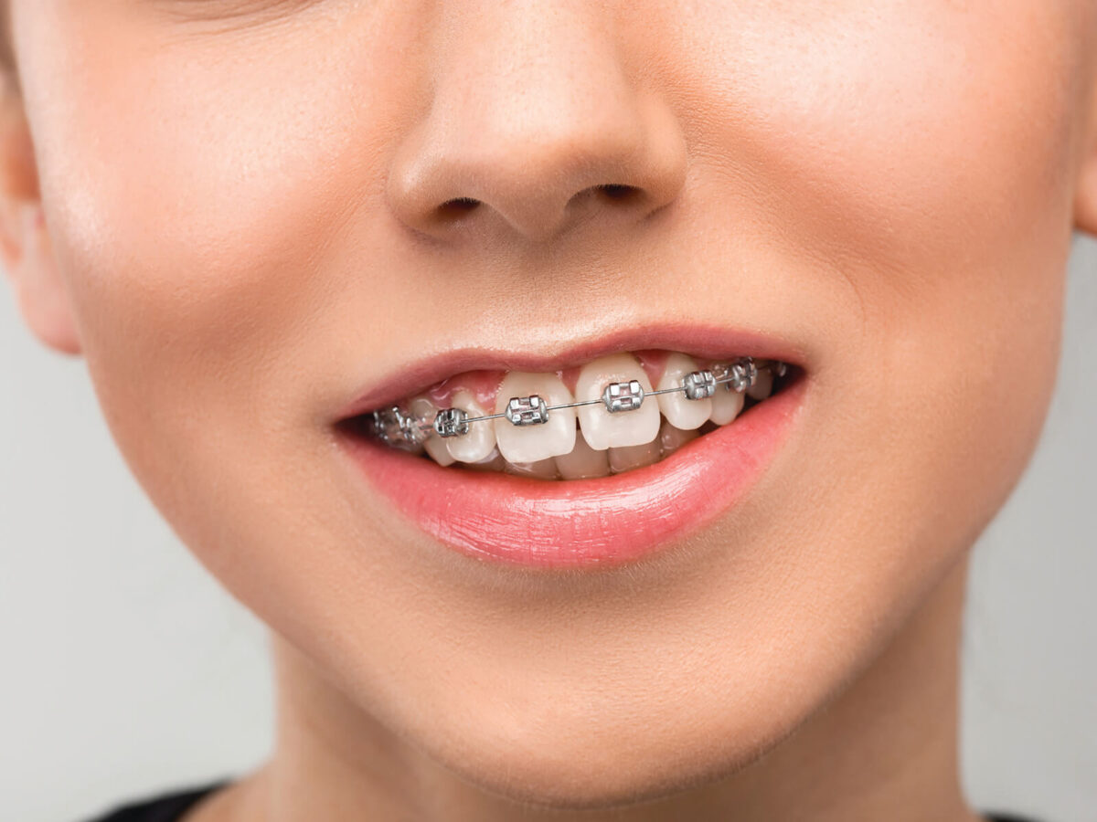 6 Tips For Your First Week of Having Braces