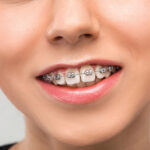 6 Tips For Your First Week of Having Braces