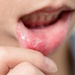 Everything You Need To Know About Mouth Ulcers