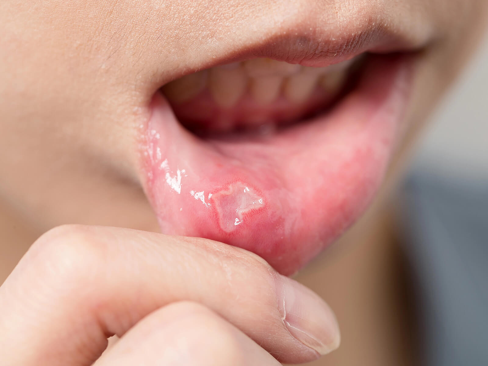 Everything You Need To Know About Mouth Ulcers